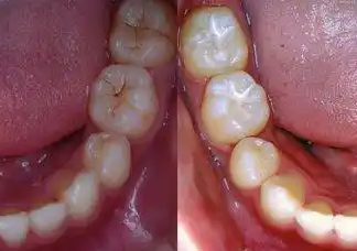 窩溝封閉、涂氟防蛀